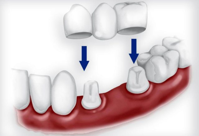 Протезирование зубов: разновидности, актуальность, плюсы и минусы - фото1